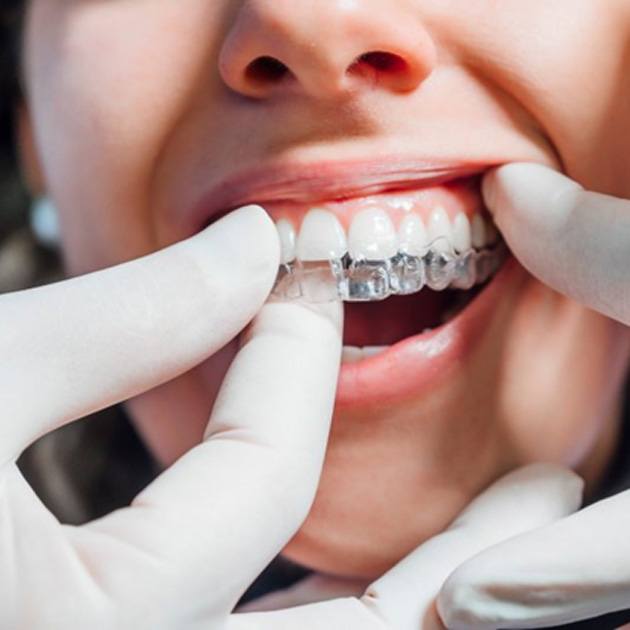 a patient having their custom Invisalign trays placed