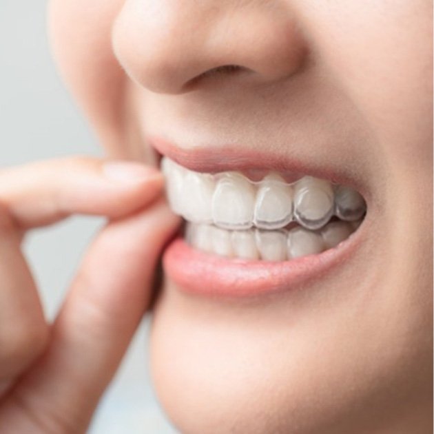 a person wearing clear Invisalign aligners