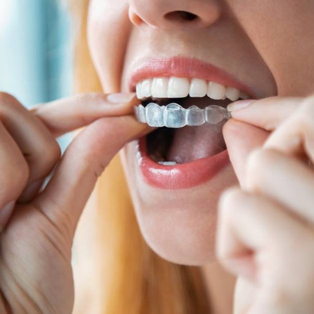 a patient putting on their Invisalign aligners