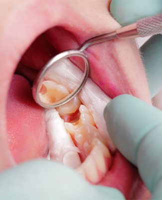 Closeup of dental mirror reflecting someone’s cavity