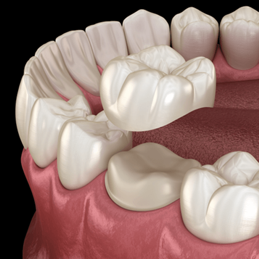 A 3D illustration of the dental crown process