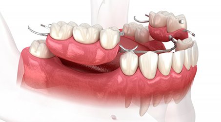 Illustration of partial dentures