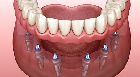 Illustration of implant dentures