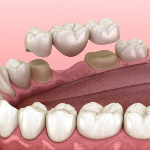 Animated smile with dental bridge restoration