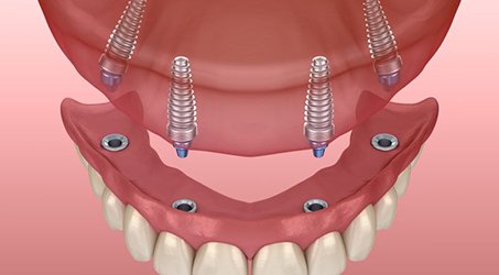 Digital image of upper implant dentures