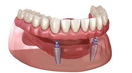 Illustration of ball-retained removable implant dentures