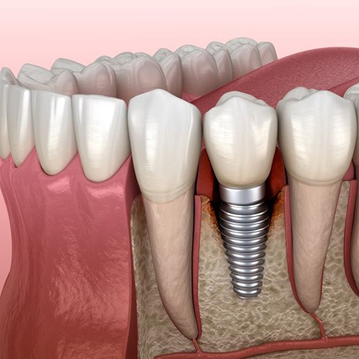 Illustration showing peri-implantitis around a dental implant