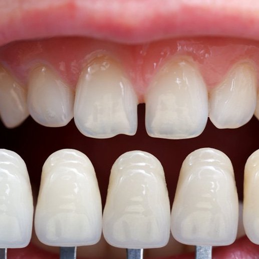 Close up of color matching veneers next to patient’s upper arch